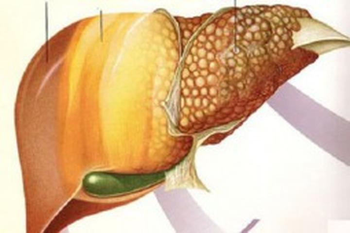 Niealkoholowe stłuszczenie wątroby