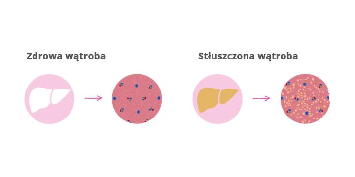 Objawy stłuszczenia wątroby