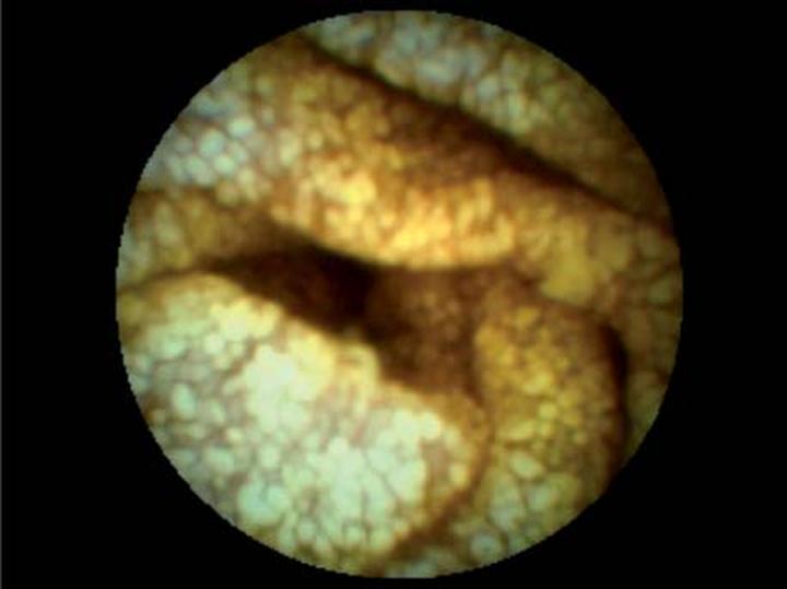 Choroba Whipple’a objawy