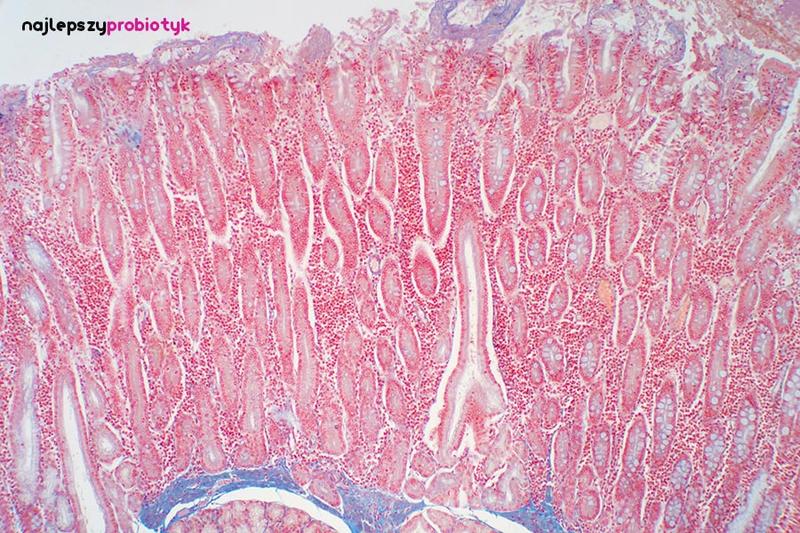 Tajemnice choroby Whipple’a: objawy, diagnostyka i leczenie, które warto znać