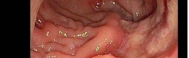 Oś jelitowo-mózgowa