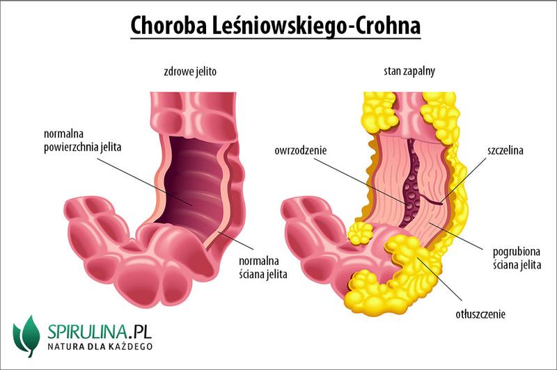 Choroba Leśniowskiego-Crohna