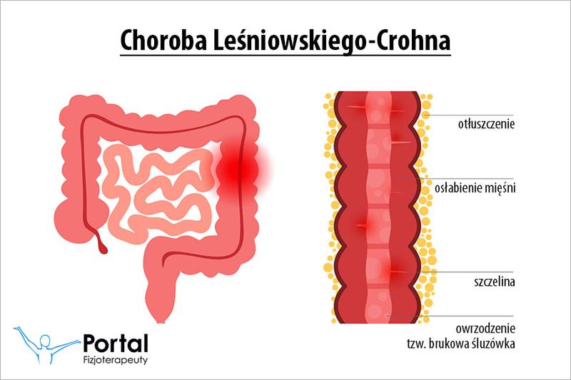 Objawy choroby Leśniowskiego-Crohna