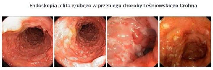 Przewlekłe zapalenie jelit